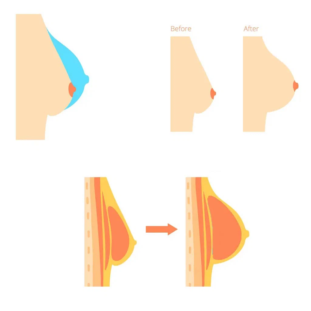 breast enhancement breast enhancement